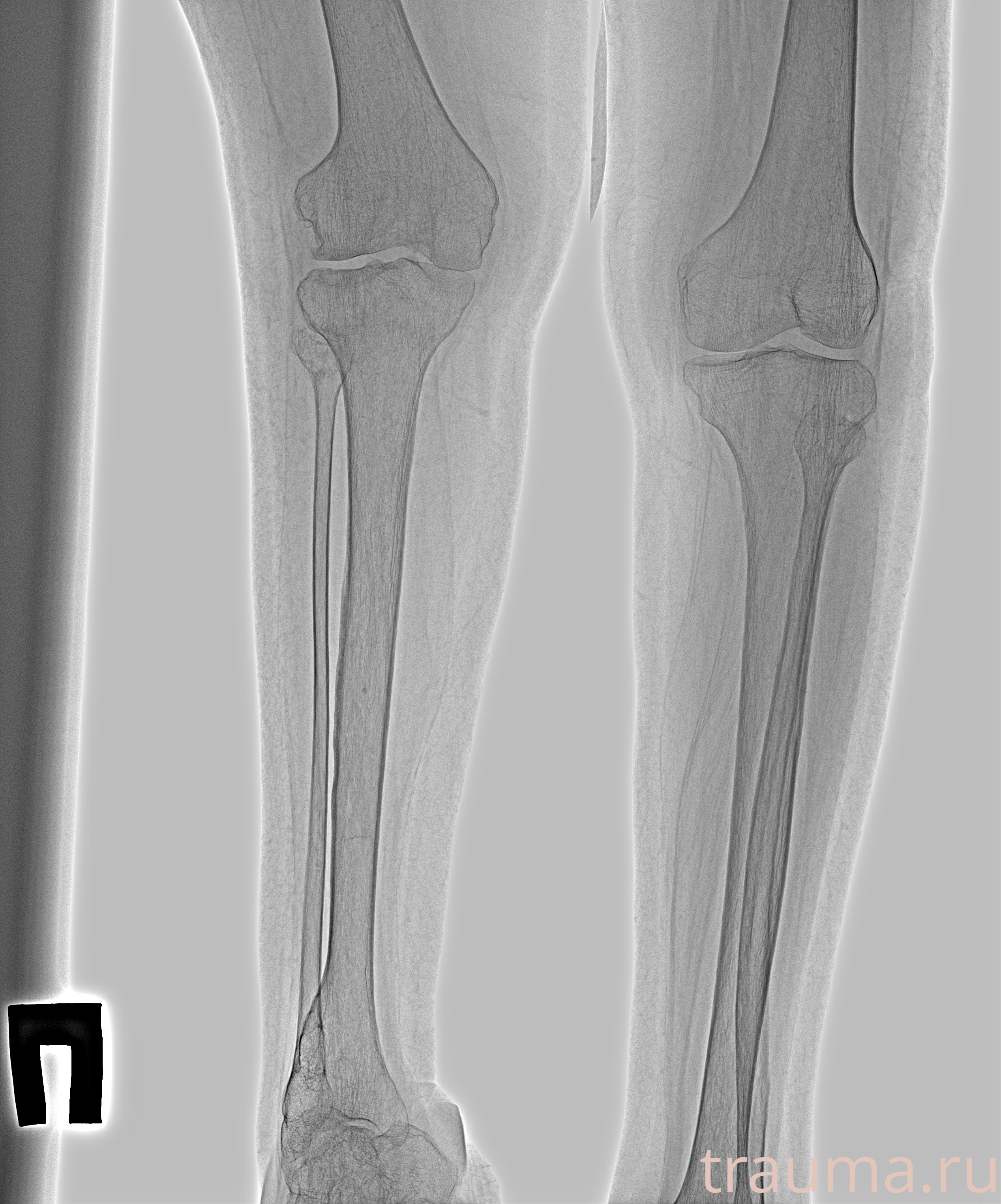 Рентген на дому: по вашему адресу приезжает врач-рентгенолог, травматолог-ортопед с мобильным рентгеновским аппаратом, проводит диагностику травмы или заболевания, делает необходимые рентгенограммы, дает рекомендации по дальнейшему лечению. Получить качественные снимки в домашних условиях возможно благодаря уникальной методике, разработанной МосРентген Центром для института  Склифосовского