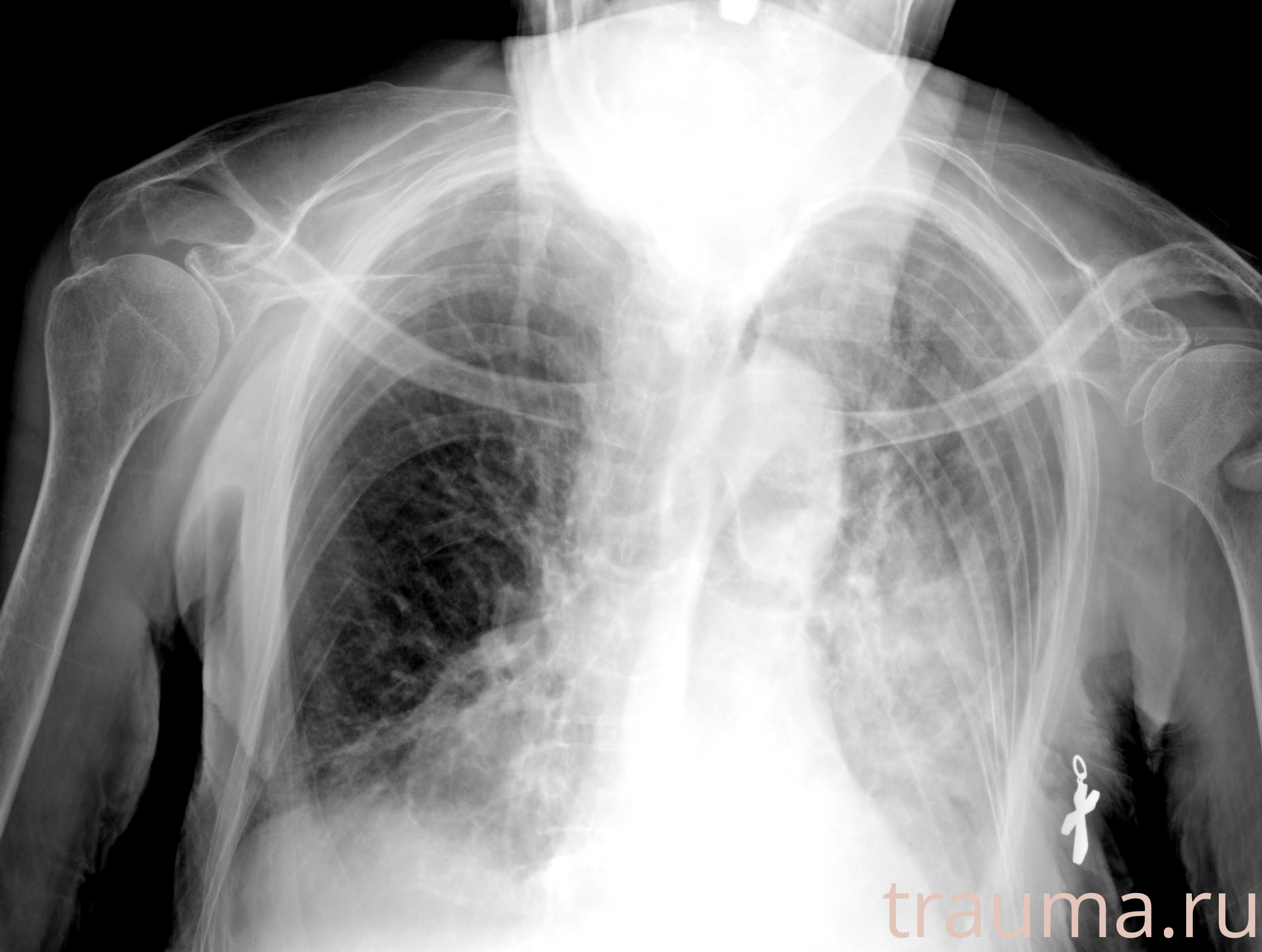 Рентген на дому: по вашему адресу приезжает врач-рентгенолог, травматолог-ортопед с мобильным рентгеновским аппаратом, проводит диагностику травмы или заболевания, делает необходимые рентгенограммы, дает рекомендации по дальнейшему лечению. Получить качественные снимки в домашних условиях возможно благодаря уникальной методике, разработанной МосРентген Центром для института  Склифосовского