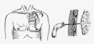 Оперативное вмешательство на 15 сутки после проникающего ранения грудной клетки