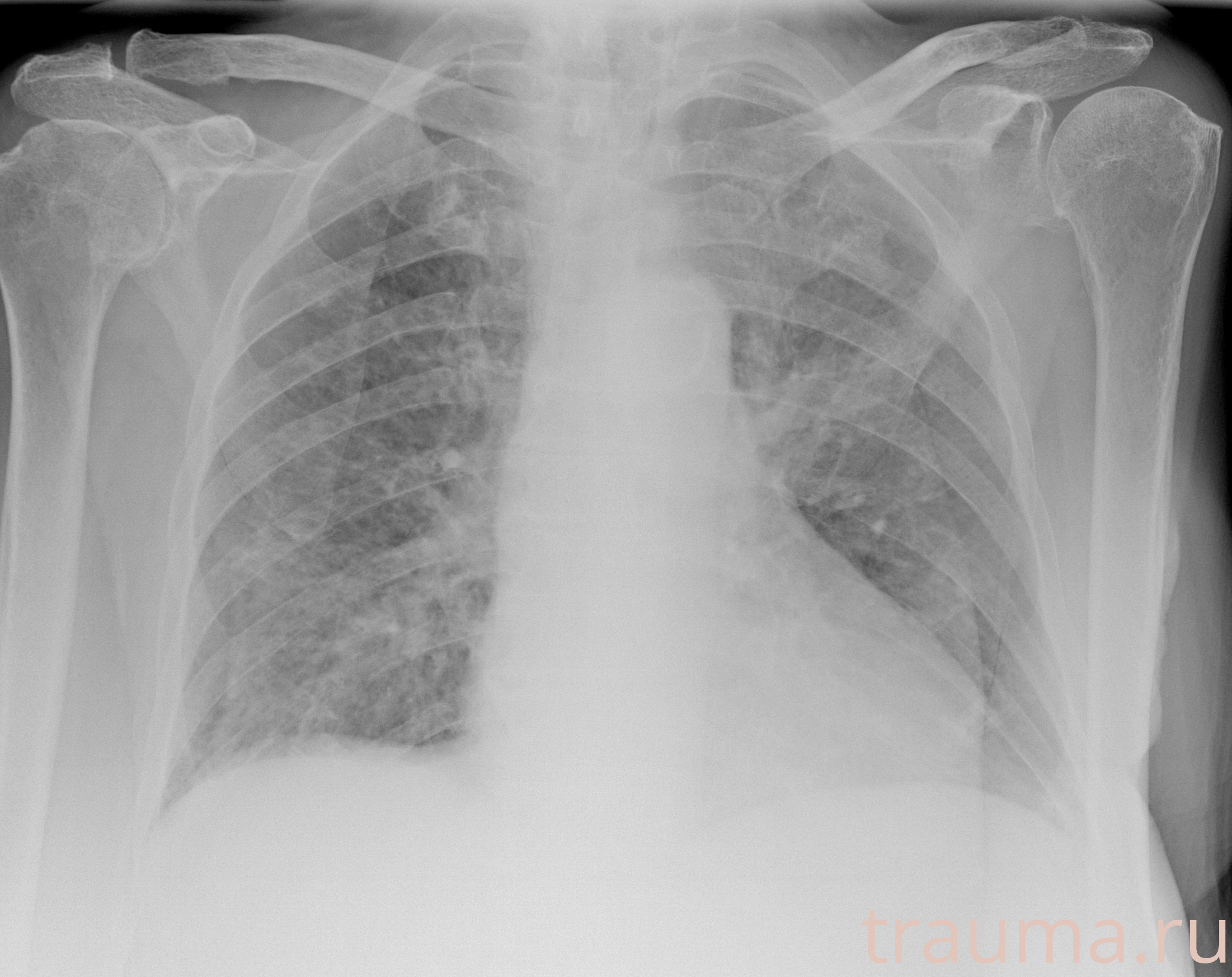 Рентген на дому: по вашему адресу приезжает врач-рентгенолог, травматолог-ортопед с мобильным рентгеновским аппаратом, проводит диагностику травмы или заболевания, делает необходимые рентгенограммы, дает рекомендации по дальнейшему лечению. Получить качественные снимки в домашних условиях возможно благодаря уникальной методике, разработанной МосРентген Центром для института  Склифосовского