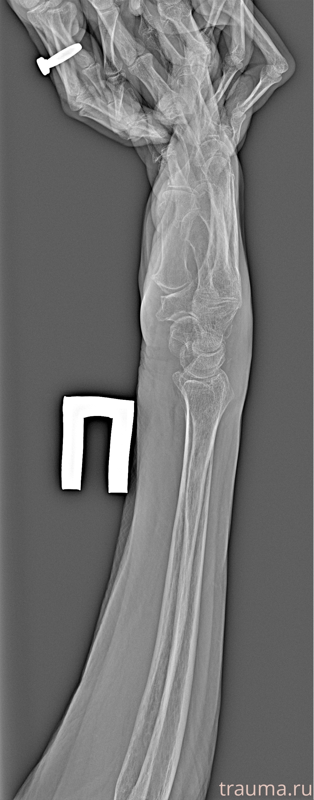 Рентген на дому: по вашему адресу приезжает врач-рентгенолог, травматолог-ортопед с мобильным рентгеновским аппаратом, проводит диагностику травмы или заболевания, делает необходимые рентгенограммы, дает рекомендации по дальнейшему лечению. Получить качественные снимки в домашних условиях возможно благодаря уникальной методике, разработанной МосРентген Центром для института  Склифосовского