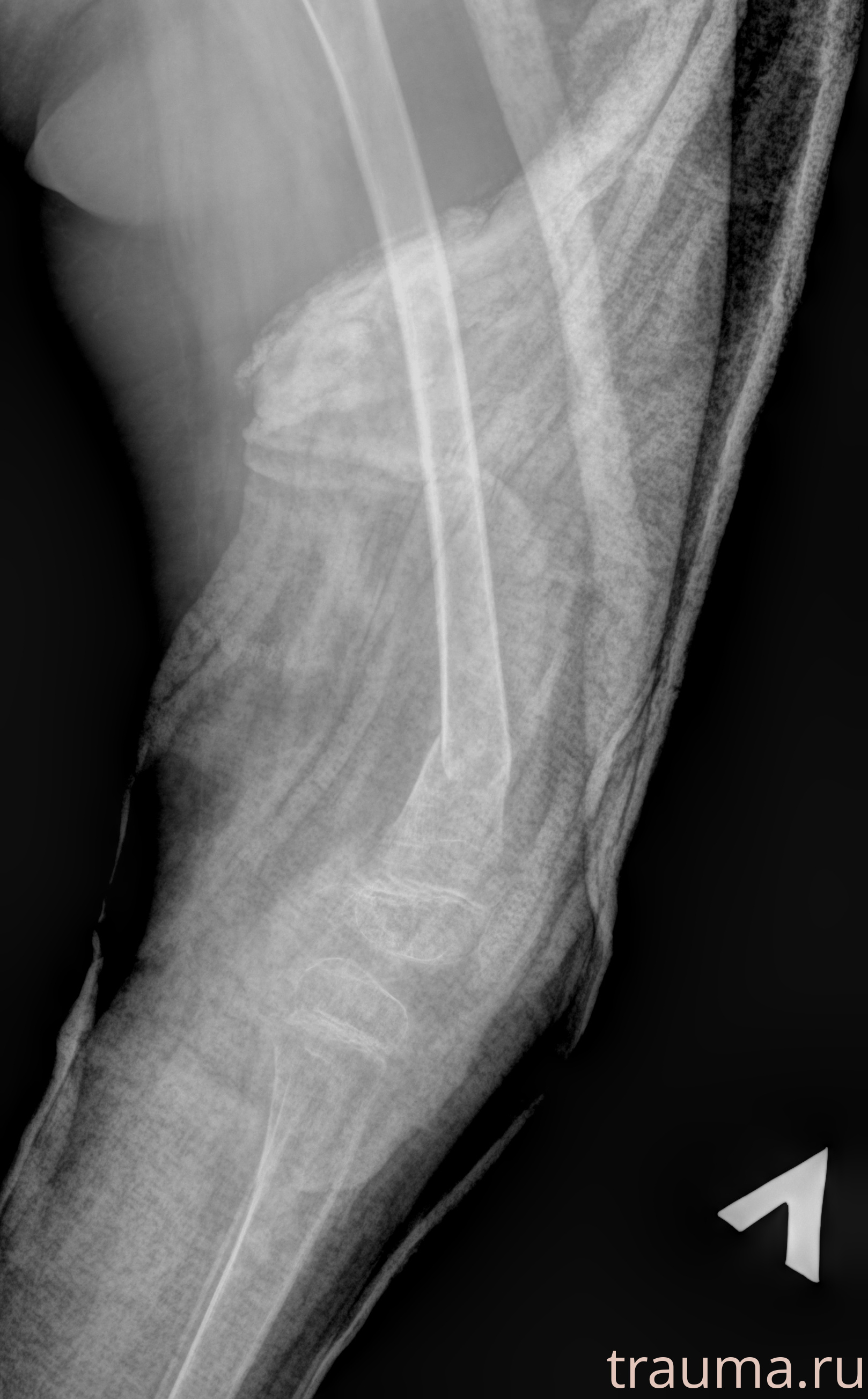 Рентген на дому: по вашему адресу приезжает врач-рентгенолог, травматолог-ортопед с мобильным рентгеновским аппаратом, проводит диагностику травмы или заболевания, делает необходимые рентгенограммы, дает рекомендации по дальнейшему лечению. Получить качественные снимки в домашних условиях возможно благодаря уникальной методике, разработанной МосРентген Центром для института  Склифосовского