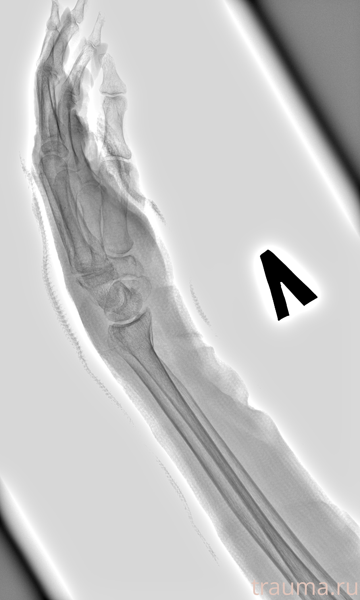 Рентген на дому: по вашему адресу приезжает врач-рентгенолог, травматолог-ортопед с мобильным рентгеновским аппаратом, проводит диагностику травмы или заболевания, делает необходимые рентгенограммы, дает рекомендации по дальнейшему лечению. Получить качественные снимки в домашних условиях возможно благодаря уникальной методике, разработанной МосРентген Центром для института  Склифосовского