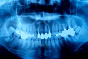 Ортопантомограмма челюстей и лицевого скелета