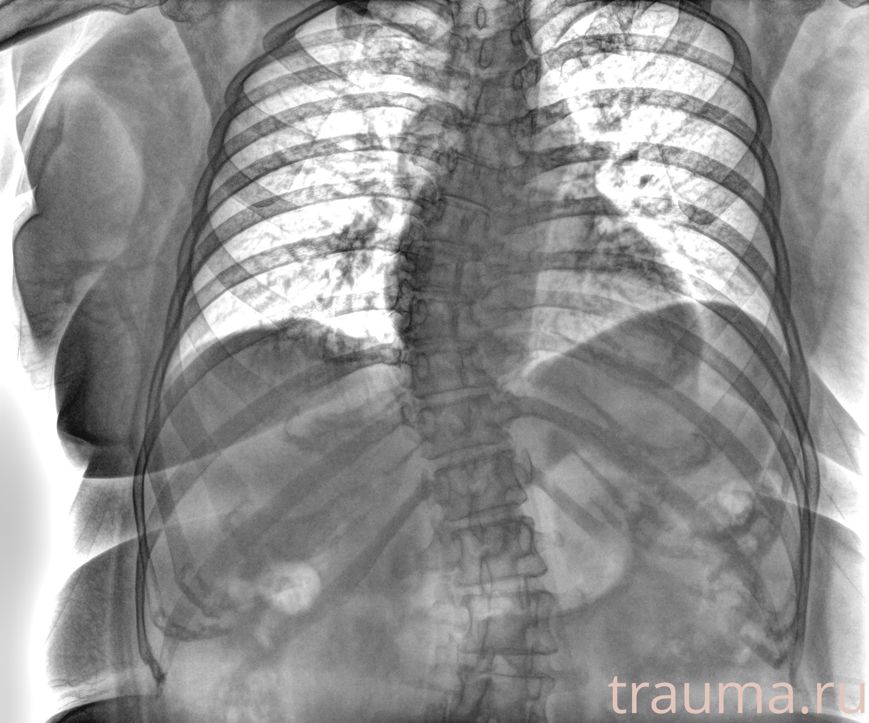 Рентген на дому: по вашему адресу приезжает врач-рентгенолог, травматолог-ортопед с мобильным рентгеновским аппаратом, проводит диагностику травмы или заболевания, делает необходимые рентгенограммы, дает рекомендации по дальнейшему лечению. Получить качественные снимки в домашних условиях возможно благодаря уникальной методике, разработанной МосРентген Центром для института  Склифосовского