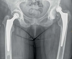 Хирургическое лечение вывихов головки эндопротеза тазобедренного сустава