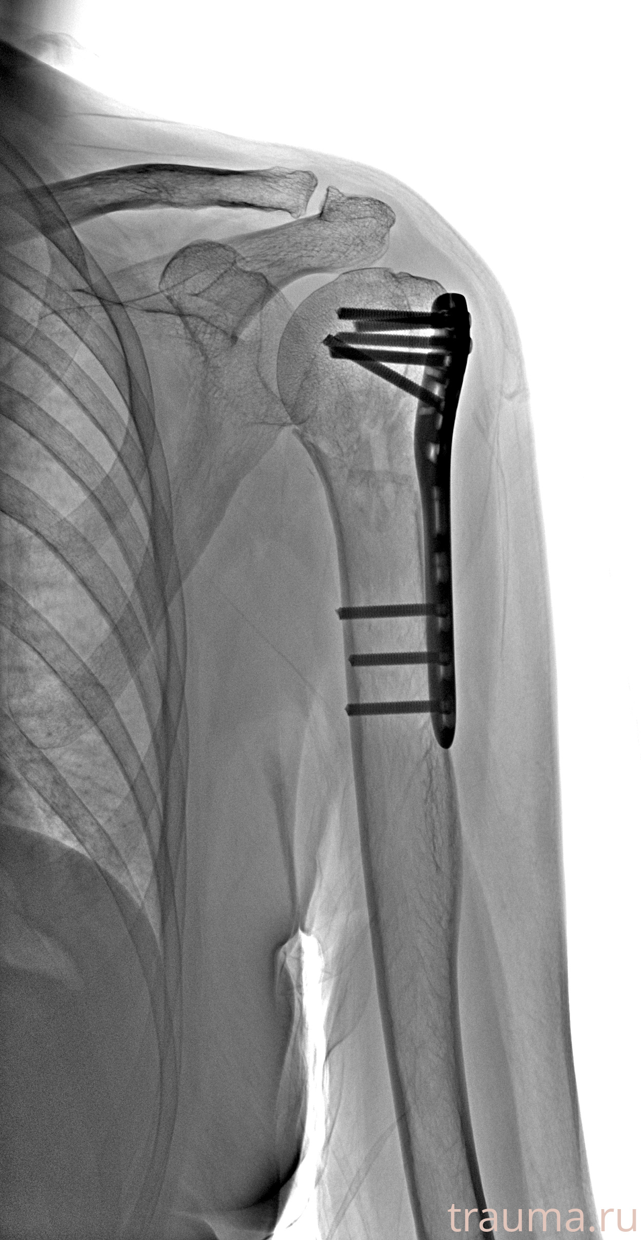 Рентген на дому: по вашему адресу приезжает врач-рентгенолог, травматолог-ортопед с мобильным рентгеновским аппаратом, проводит диагностику травмы или заболевания, делает необходимые рентгенограммы, дает рекомендации по дальнейшему лечению. Получить качественные снимки в домашних условиях возможно благодаря уникальной методике, разработанной МосРентген Центром для института  Склифосовского
