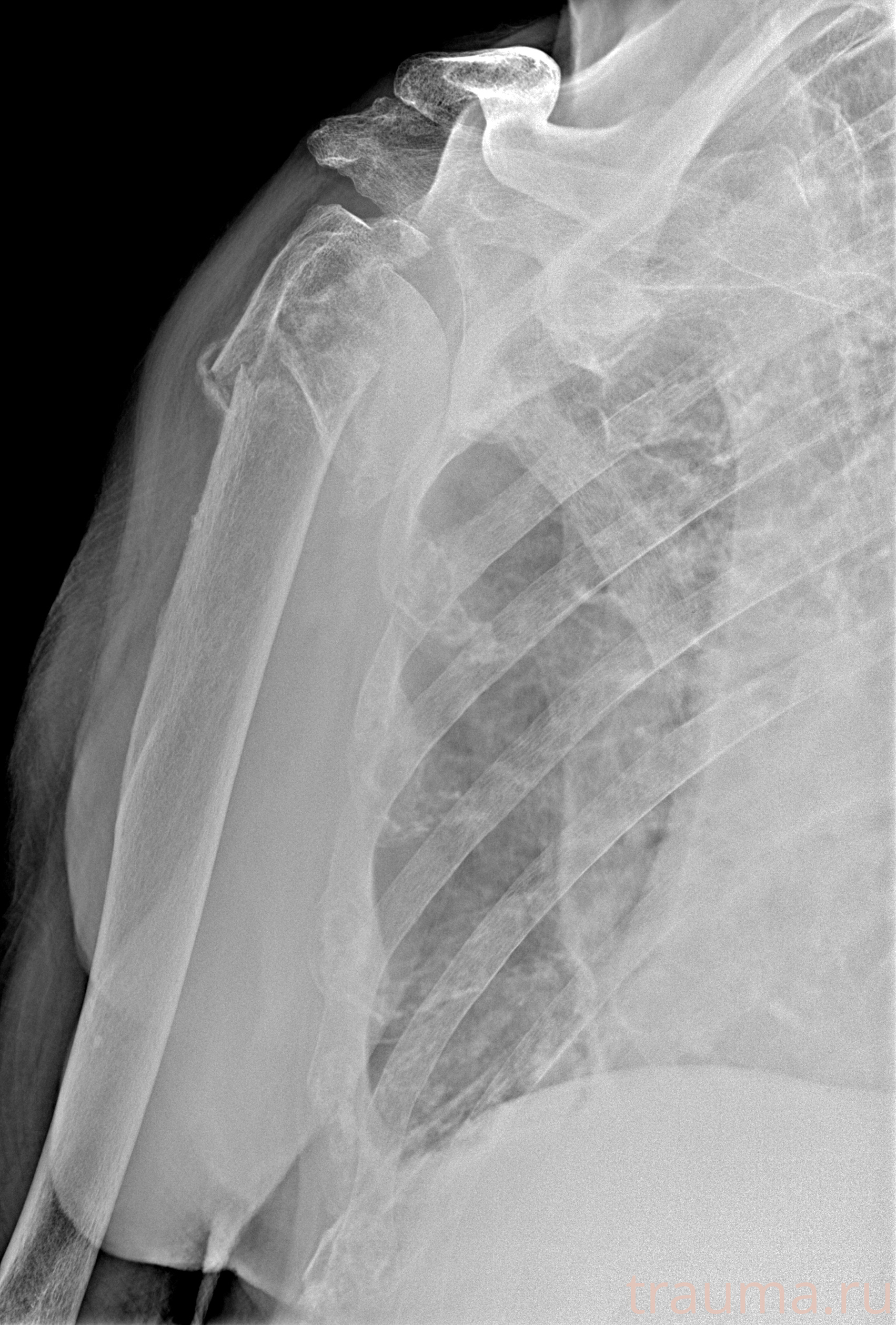 Рентген на дому: по вашему адресу приезжает врач-рентгенолог, травматолог-ортопед с мобильным рентгеновским аппаратом, проводит диагностику травмы или заболевания, делает необходимые рентгенограммы, дает рекомендации по дальнейшему лечению. Получить качественные снимки в домашних условиях возможно благодаря уникальной методике, разработанной МосРентген Центром для института  Склифосовского