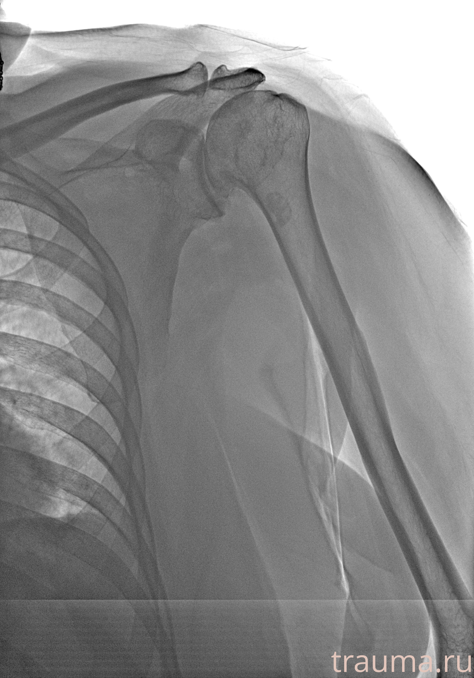 Рентген на дому: по вашему адресу приезжает врач-рентгенолог, травматолог-ортопед с мобильным рентгеновским аппаратом, проводит диагностику травмы или заболевания, делает необходимые рентгенограммы, дает рекомендации по дальнейшему лечению. Получить качественные снимки в домашних условиях возможно благодаря уникальной методике, разработанной МосРентген Центром для института  Склифосовского