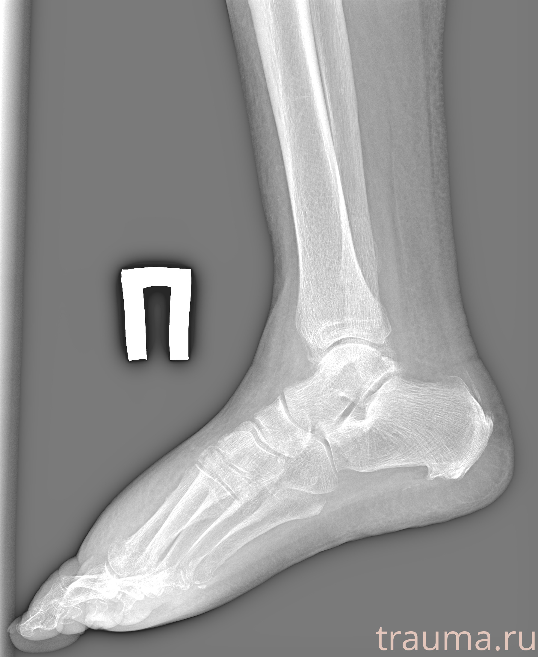 Рентген на дому: по вашему адресу приезжает врач-рентгенолог, травматолог-ортопед с мобильным рентгеновским аппаратом, проводит диагностику травмы или заболевания, делает необходимые рентгенограммы, дает рекомендации по дальнейшему лечению. Получить качественные снимки в домашних условиях возможно благодаря уникальной методике, разработанной МосРентген Центром для института  Склифосовского