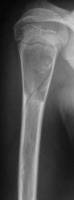 Чрескостный остеосинтез в хирургическом лечении костных кист