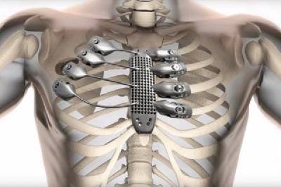 Человеку впервые пересадили ребра, напечатанные на 3D-принтере