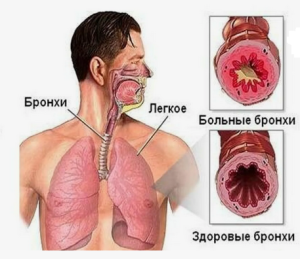 Возможность достижения клинической ремиссии у пациентов с тяжелой бронхиальной астмой, получающих генно-инженерную биологическую терапию

