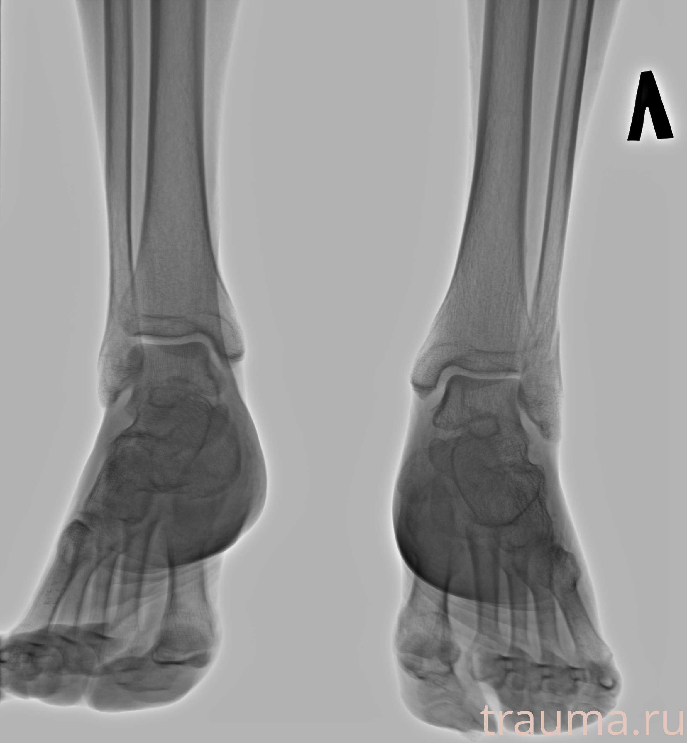 Рентген на дому: по вашему адресу приезжает врач-рентгенолог, травматолог-ортопед с мобильным рентгеновским аппаратом, проводит диагностику травмы или заболевания, делает необходимые рентгенограммы, дает рекомендации по дальнейшему лечению. Получить качественные снимки в домашних условиях возможно благодаря уникальной методике, разработанной МосРентген Центром для института  Склифосовского