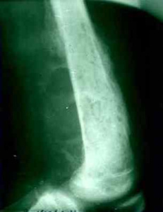 Курс медицинской рентгенологии. Рентгенодиагностика. Гнойные заболевания костей и суставов. Часть 2. Глава 6