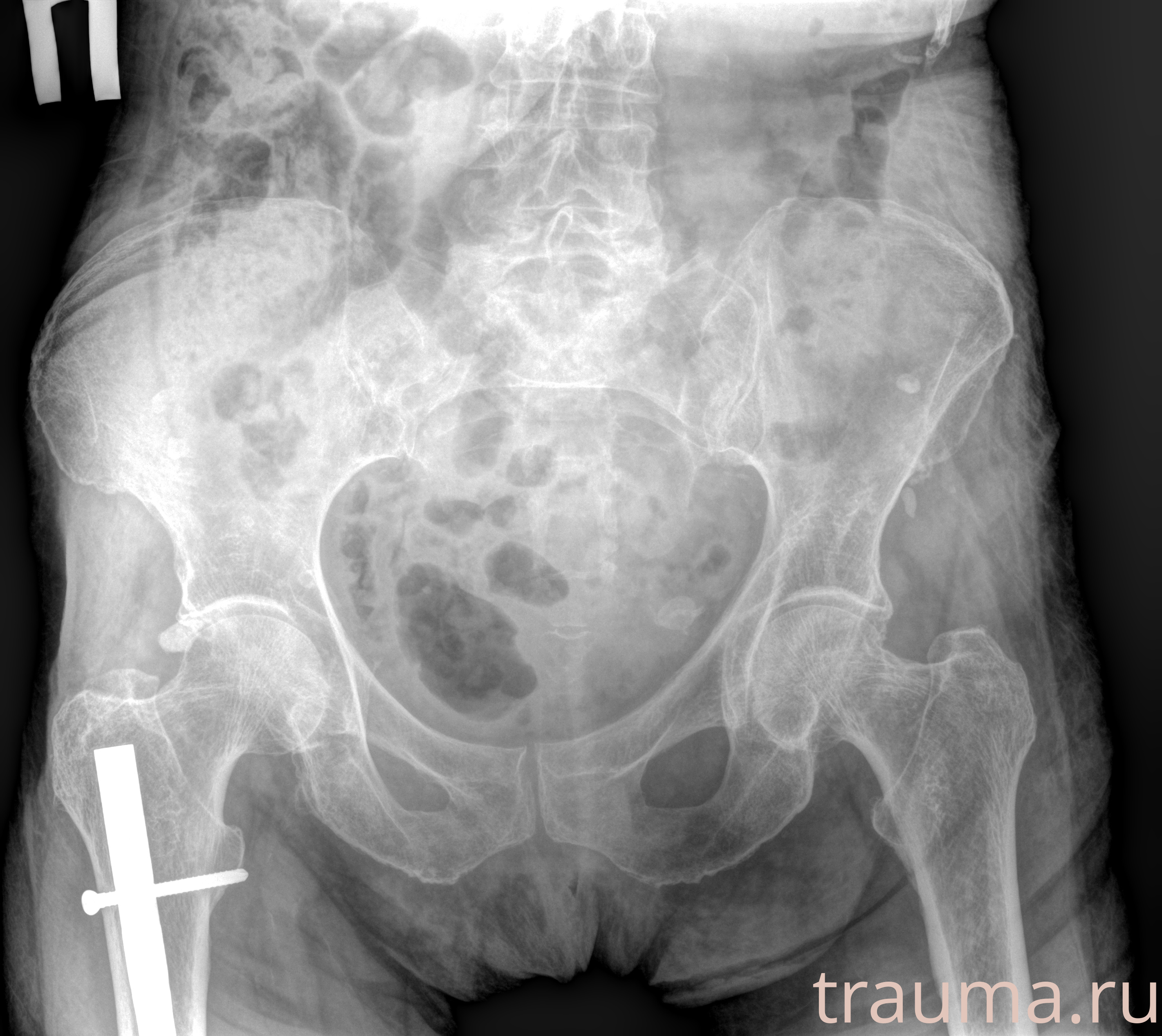 Рентген на дому: по вашему адресу приезжает врач-рентгенолог, травматолог-ортопед с мобильным рентгеновским аппаратом, проводит диагностику травмы или заболевания, делает необходимые рентгенограммы, дает рекомендации по дальнейшему лечению. Получить качественные снимки в домашних условиях возможно благодаря уникальной методике, разработанной МосРентген Центром для института  Склифосовского