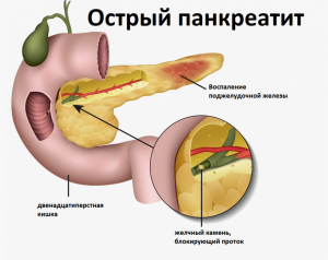 Постманипуляционный панкреотит:актуальность прблемы, сложности диагностики и нерешенные проблемы