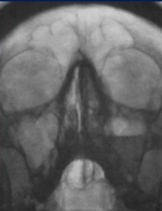 Особенности лучевой диагностики COVID-ассоциированного мукормикоза околоносовых пазух: проспективное исследование