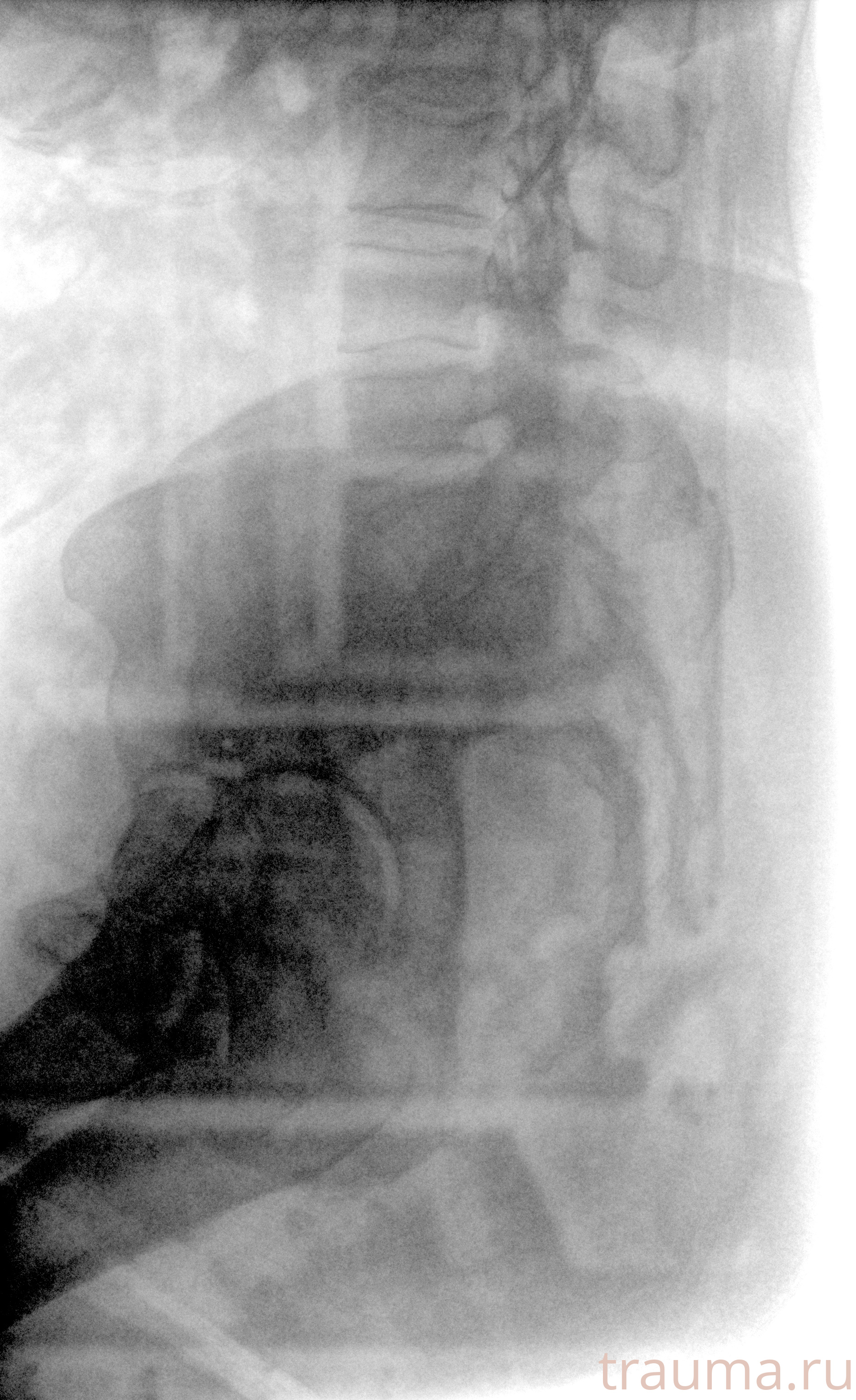 Рентген на дому: по вашему адресу приезжает врач-рентгенолог, травматолог-ортопед с мобильным рентгеновским аппаратом, проводит диагностику травмы или заболевания, делает необходимые рентгенограммы, дает рекомендации по дальнейшему лечению. Получить качественные снимки в домашних условиях возможно благодаря уникальной методике, разработанной МосРентген Центром для института  Склифосовского