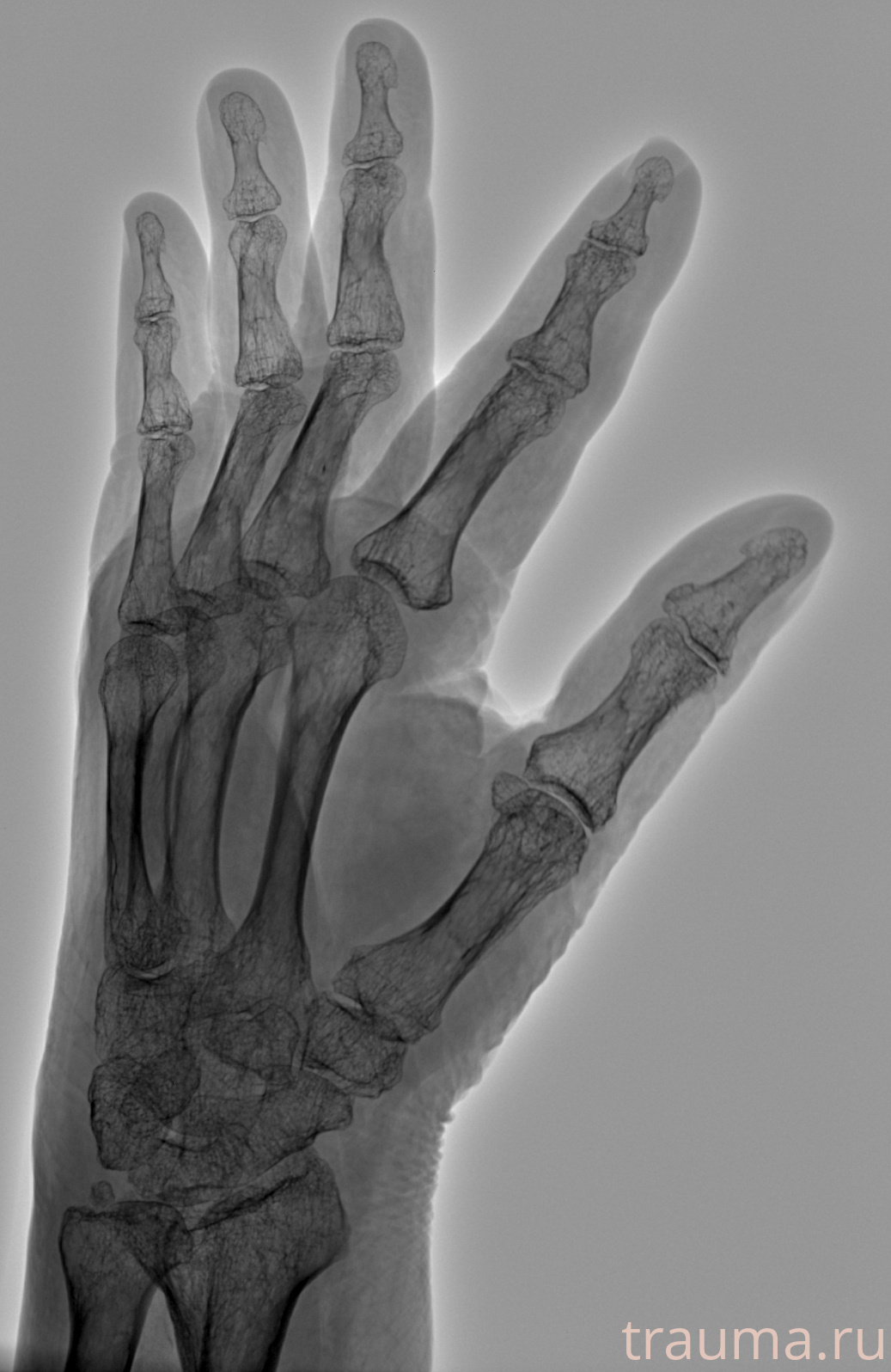 Рентген на дому: по вашему адресу приезжает врач-рентгенолог, травматолог-ортопед с мобильным рентгеновским аппаратом, проводит диагностику травмы или заболевания, делает необходимые рентгенограммы, дает рекомендации по дальнейшему лечению. Получить качественные снимки в домашних условиях возможно благодаря уникальной методике, разработанной МосРентген Центром для института  Склифосовского