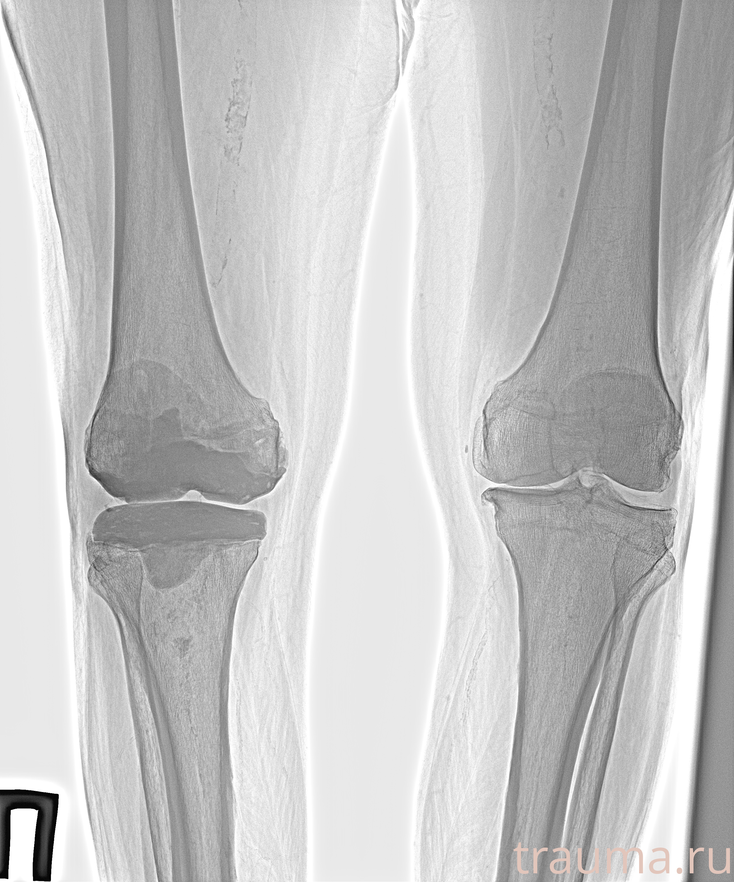 Рентген на дому: по вашему адресу приезжает врач-рентгенолог, травматолог-ортопед с мобильным рентгеновским аппаратом, проводит диагностику травмы или заболевания, делает необходимые рентгенограммы, дает рекомендации по дальнейшему лечению. Получить качественные снимки в домашних условиях возможно благодаря уникальной методике, разработанной МосРентген Центром для института  Склифосовского