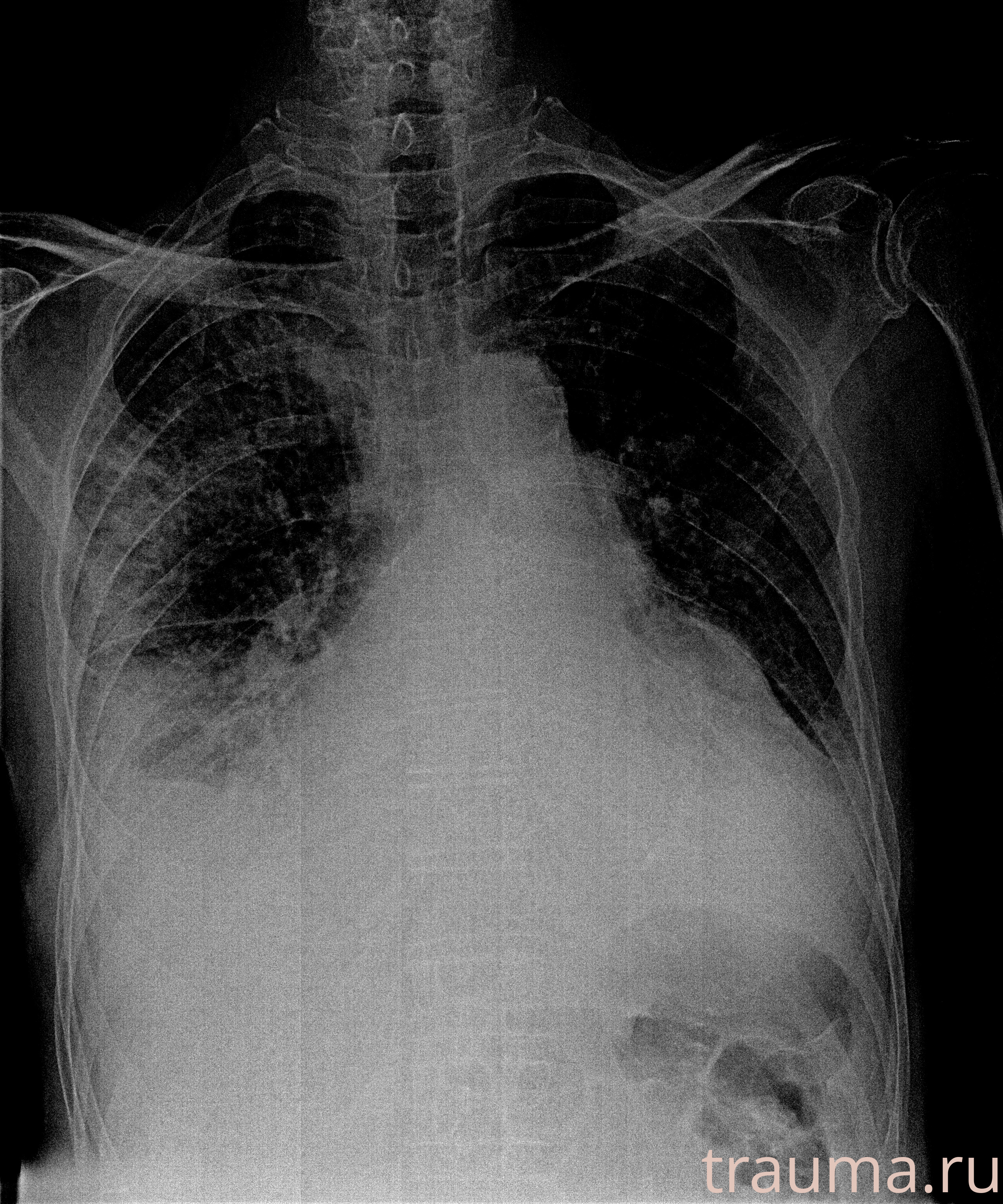 Рентген на дому: по вашему адресу приезжает врач-рентгенолог, травматолог-ортопед с мобильным рентгеновским аппаратом, проводит диагностику травмы или заболевания, делает необходимые рентгенограммы, дает рекомендации по дальнейшему лечению. Получить качественные снимки в домашних условиях возможно благодаря уникальной методике, разработанной МосРентген Центром для института  Склифосовского