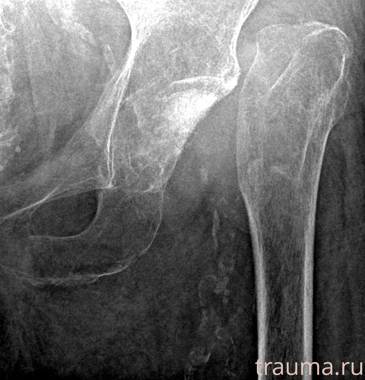 Рентген на дому: по вашему адресу приезжает врач-рентгенолог, травматолог-ортопед с мобильным рентгеновским аппаратом, проводит диагностику травмы или заболевания, делает необходимые рентгенограммы, дает рекомендации по дальнейшему лечению. Получить качественные снимки в домашних условиях возможно благодаря уникальной методике, разработанной МосРентген Центром для института  Склифосовского