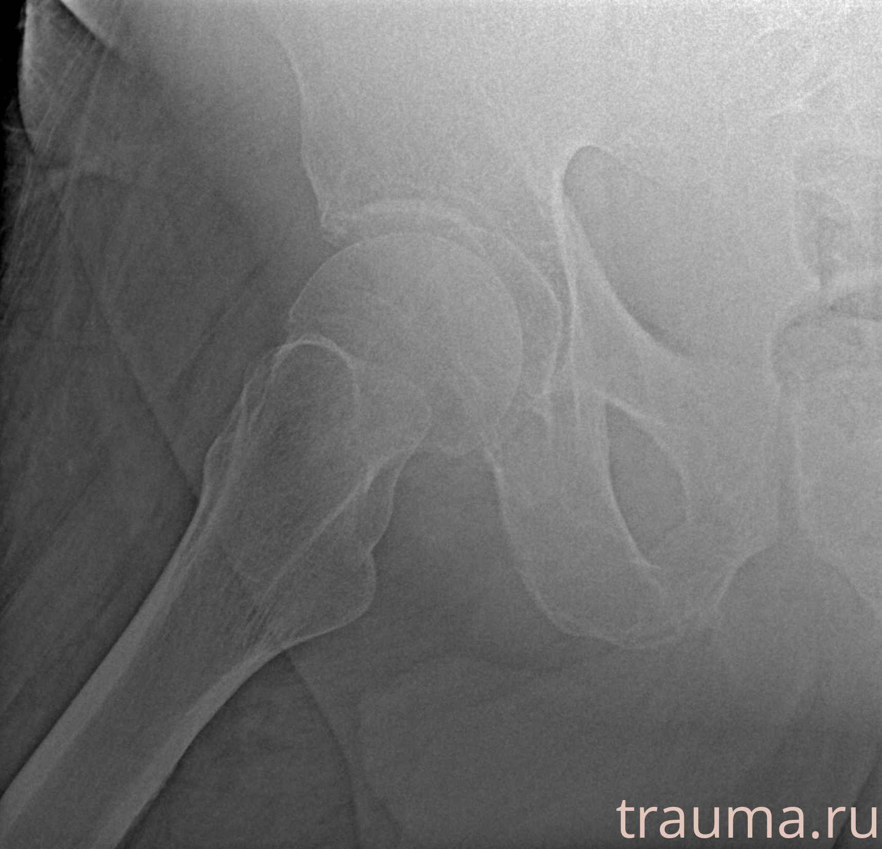 Рентген на дому: по вашему адресу приезжает врач-рентгенолог, травматолог-ортопед с мобильным рентгеновским аппаратом, проводит диагностику травмы или заболевания, делает необходимые рентгенограммы, дает рекомендации по дальнейшему лечению. Получить качественные снимки в домашних условиях возможно благодаря уникальной методике, разработанной МосРентген Центром для института  Склифосовского