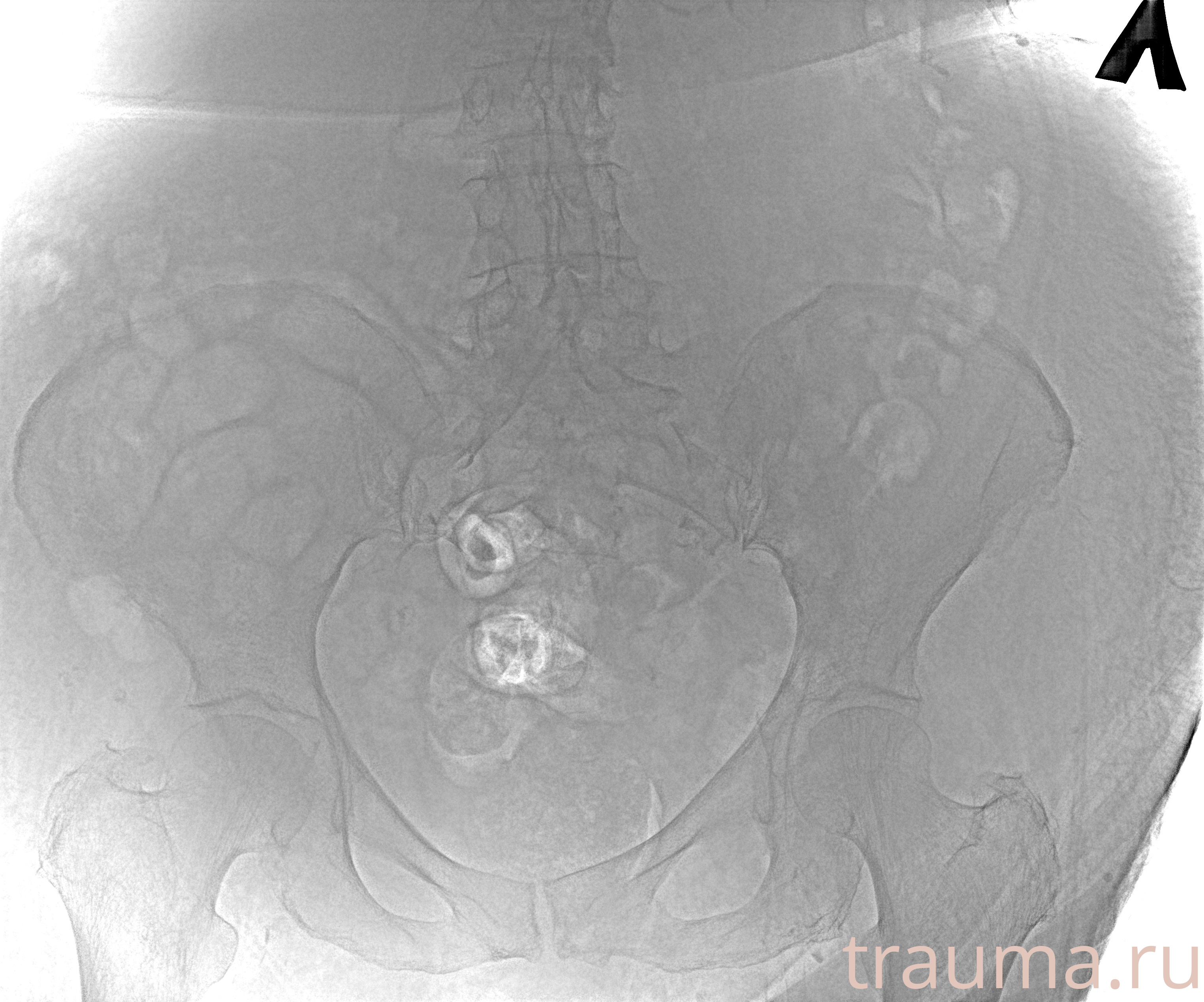 Рентген на дому: по вашему адресу приезжает врач-рентгенолог, травматолог-ортопед с мобильным рентгеновским аппаратом, проводит диагностику травмы или заболевания, делает необходимые рентгенограммы, дает рекомендации по дальнейшему лечению. Получить качественные снимки в домашних условиях возможно благодаря уникальной методике, разработанной МосРентген Центром для института  Склифосовского