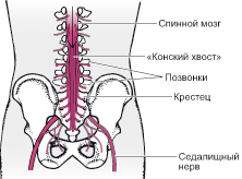 Позвоночно-тазовая диссоциация у подростка с тяжелой сочетанной травмой, осложненная синдромом «конского хвоста» 