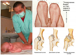 Вывих тазобедренного сустава у новорожденных: рентген признаки