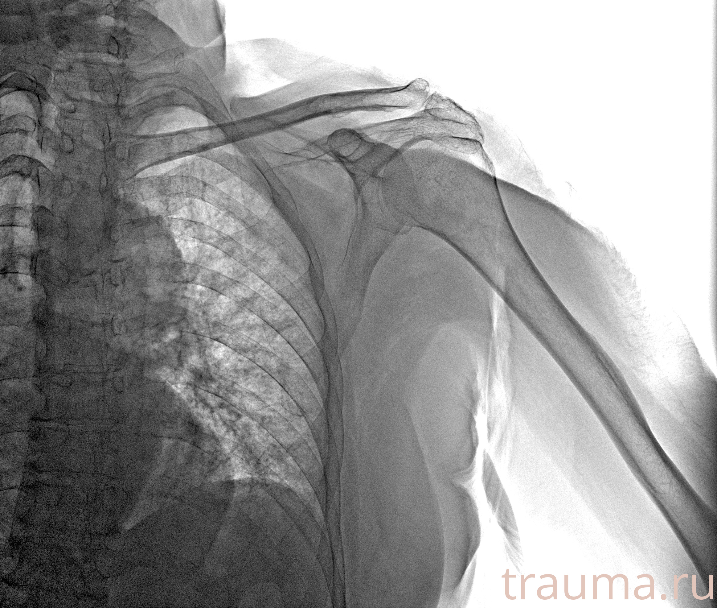 Рентген на дому: по вашему адресу приезжает врач-рентгенолог, травматолог-ортопед с мобильным рентгеновским аппаратом, проводит диагностику травмы или заболевания, делает необходимые рентгенограммы, дает рекомендации по дальнейшему лечению. Получить качественные снимки в домашних условиях возможно благодаря уникальной методике, разработанной МосРентген Центром для института  Склифосовского