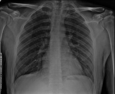 Смерть от туберкулеза в результате неправильного диагноза