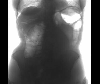 Вздутие толстой кишки на рентгене
