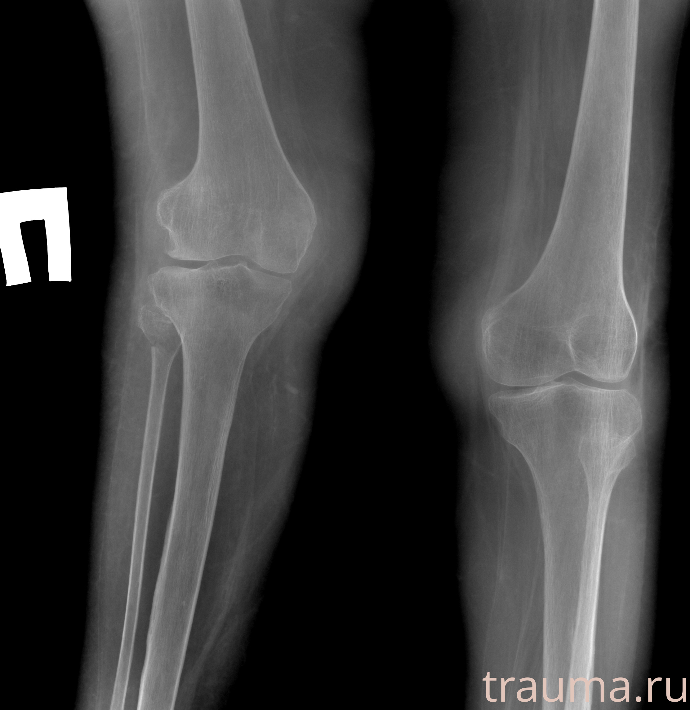 Рентген на дому: по вашему адресу приезжает врач-рентгенолог, травматолог-ортопед с мобильным рентгеновским аппаратом, проводит диагностику травмы или заболевания, делает необходимые рентгенограммы, дает рекомендации по дальнейшему лечению. Получить качественные снимки в домашних условиях возможно благодаря уникальной методике, разработанной МосРентген Центром для института  Склифосовского