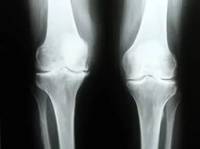 Реабилитация больных с межсегментарными дефектами костей в области коленного сустава
