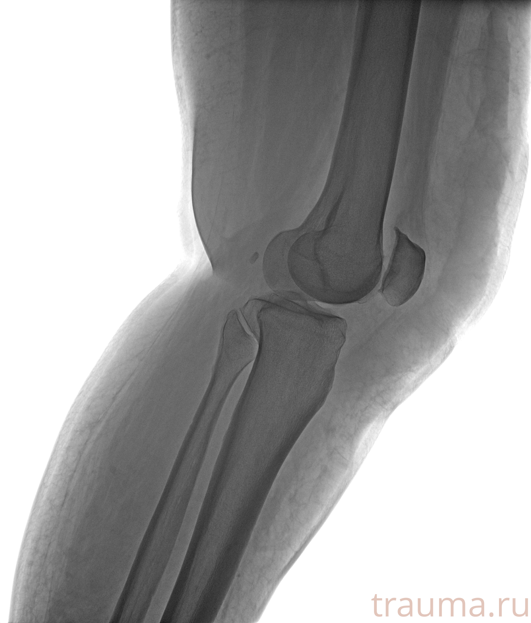 Рентген на дому: по вашему адресу приезжает врач-рентгенолог, травматолог-ортопед с мобильным рентгеновским аппаратом, проводит диагностику травмы или заболевания, делает необходимые рентгенограммы, дает рекомендации по дальнейшему лечению. Получить качественные снимки в домашних условиях возможно благодаря уникальной методике, разработанной МосРентген Центром для института  Склифосовского