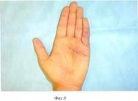Лечение двойных контрактур пальцев кисти