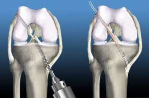 Артроскопическая пластика передней крестообразной связки коленного сустава аугментированным  HAMSTRING трансплантантом(автореферат диссертации на соискание ученой степени кандидата медицинских наук)