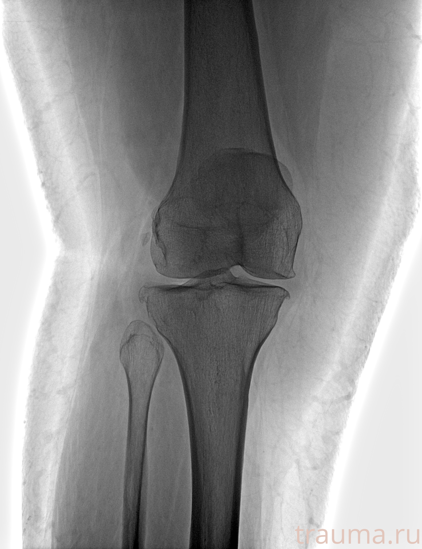 Рентген на дому: по вашему адресу приезжает врач-рентгенолог, травматолог-ортопед с мобильным рентгеновским аппаратом, проводит диагностику травмы или заболевания, делает необходимые рентгенограммы, дает рекомендации по дальнейшему лечению. Получить качественные снимки в домашних условиях возможно благодаря уникальной методике, разработанной МосРентген Центром для института  Склифосовского