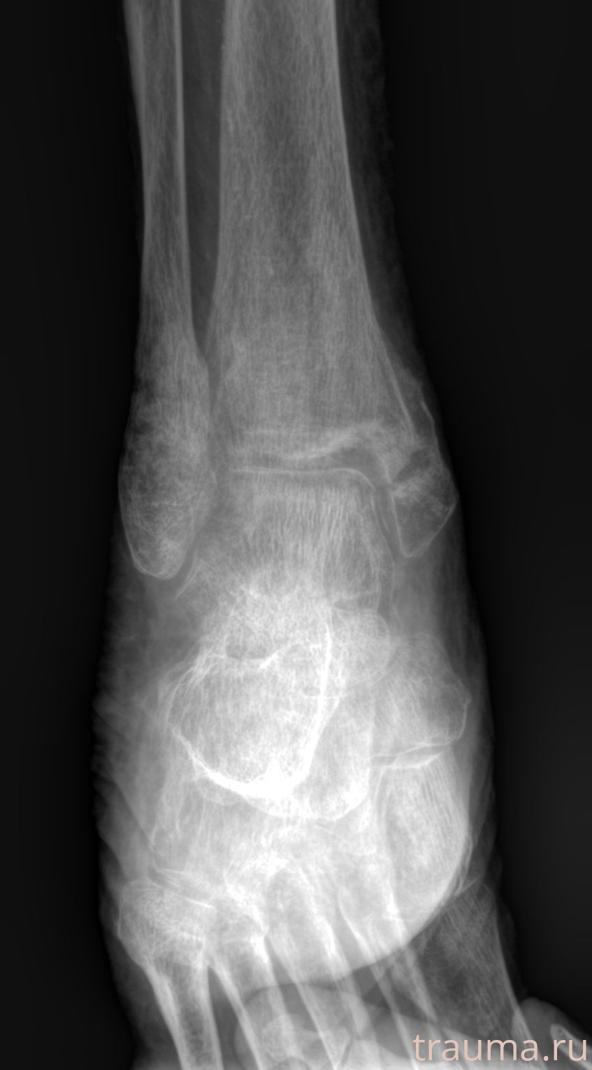 Рентген на дому: по вашему адресу приезжает врач-рентгенолог, травматолог-ортопед с мобильным рентгеновским аппаратом, проводит диагностику травмы или заболевания, делает необходимые рентгенограммы, дает рекомендации по дальнейшему лечению. Получить качественные снимки в домашних условиях возможно благодаря уникальной методике, разработанной МосРентген Центром для института  Склифосовского