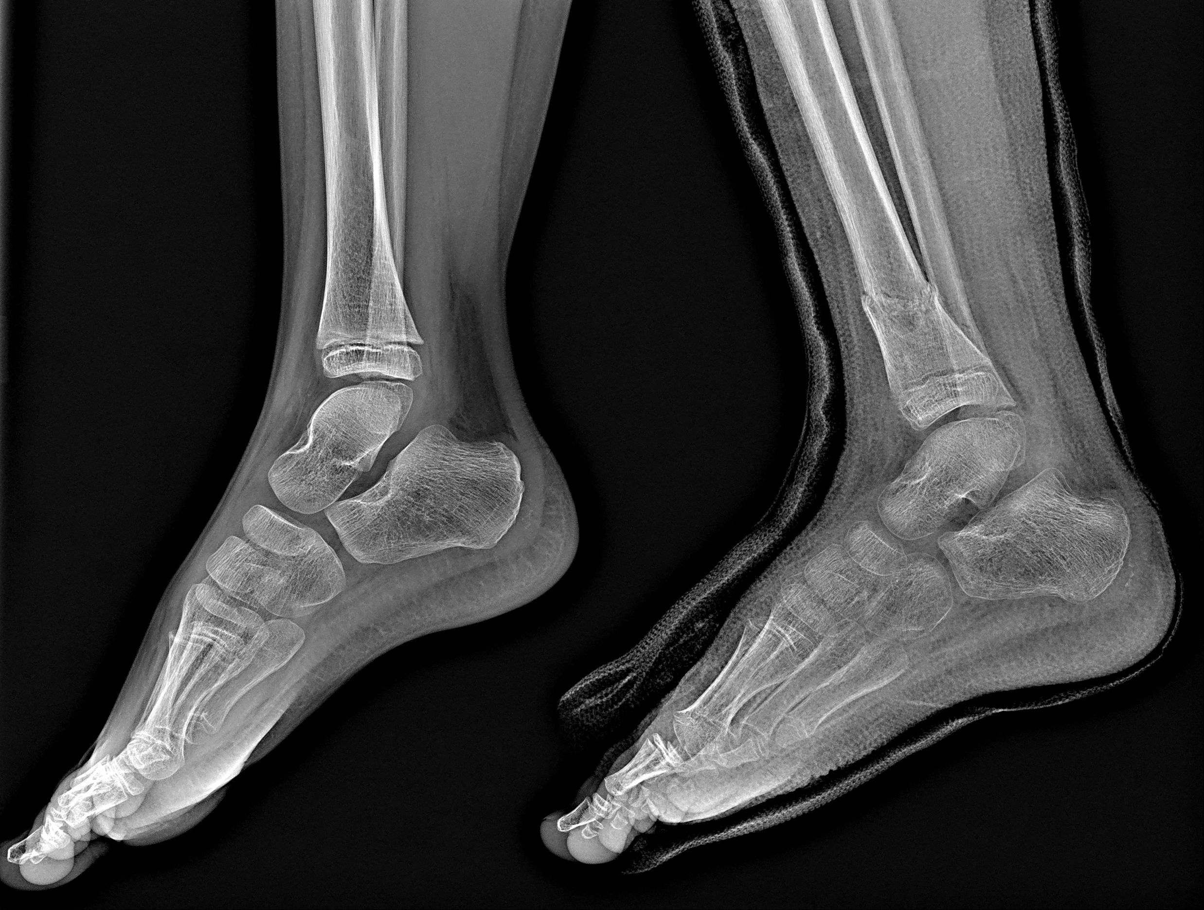 фото малоберцовой кости на ноге