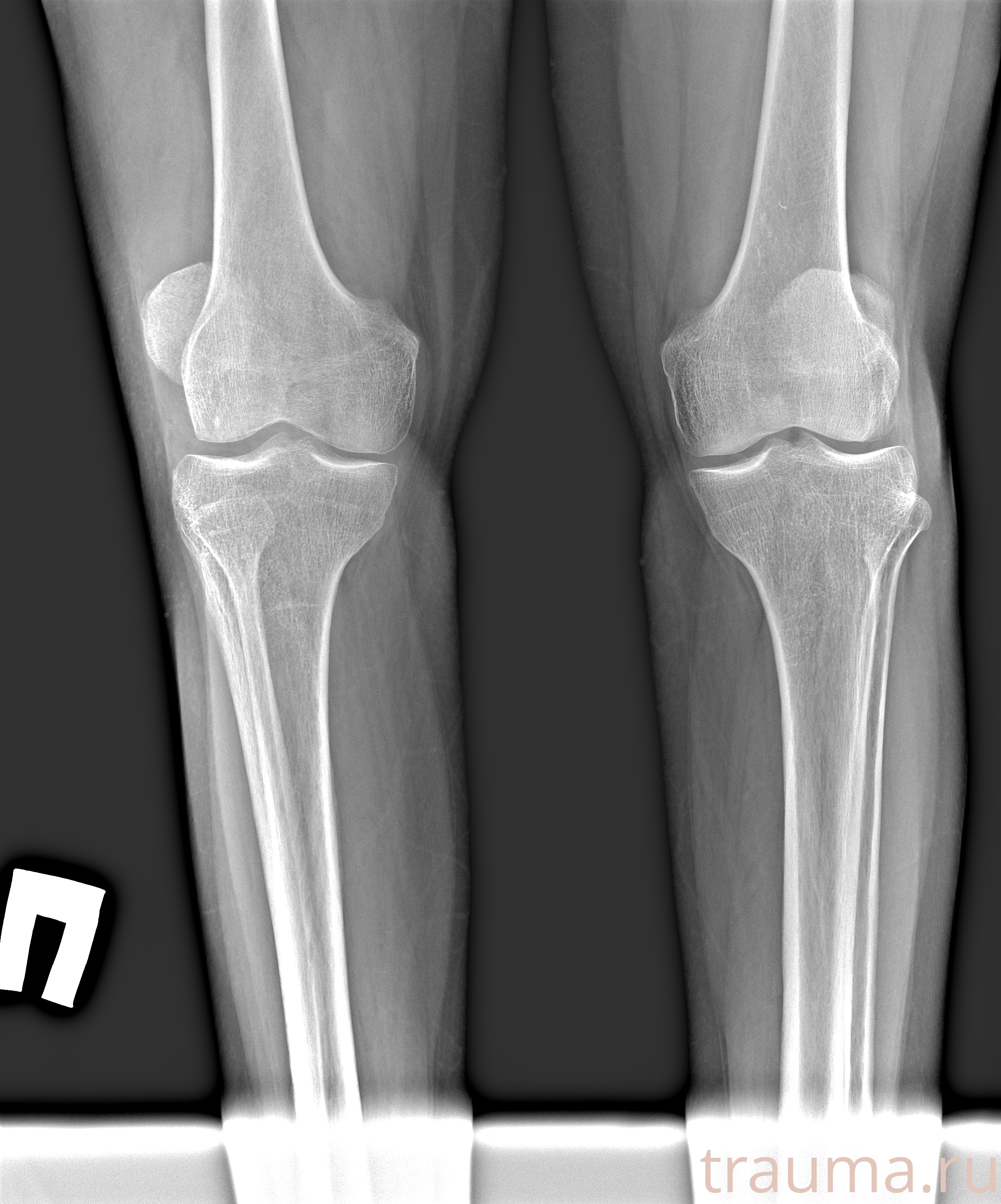 Рентген на дому: по вашему адресу приезжает врач-рентгенолог, травматолог-ортопед с мобильным рентгеновским аппаратом, проводит диагностику травмы или заболевания, делает необходимые рентгенограммы, дает рекомендации по дальнейшему лечению. Получить качественные снимки в домашних условиях возможно благодаря уникальной методике, разработанной МосРентген Центром для института  Склифосовского