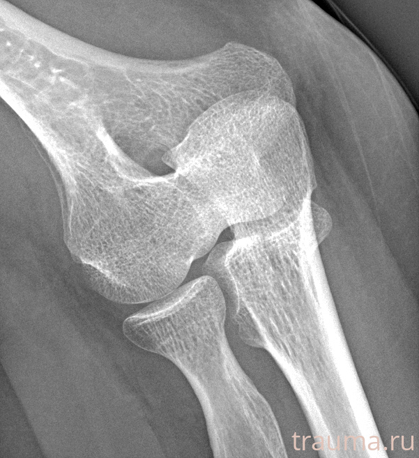 Рентген на дому: по вашему адресу приезжает врач-рентгенолог, травматолог-ортопед с мобильным рентгеновским аппаратом, проводит диагностику травмы или заболевания, делает необходимые рентгенограммы, дает рекомендации по дальнейшему лечению. Получить качественные снимки в домашних условиях возможно благодаря уникальной методике, разработанной МосРентген Центром для института  Склифосовского