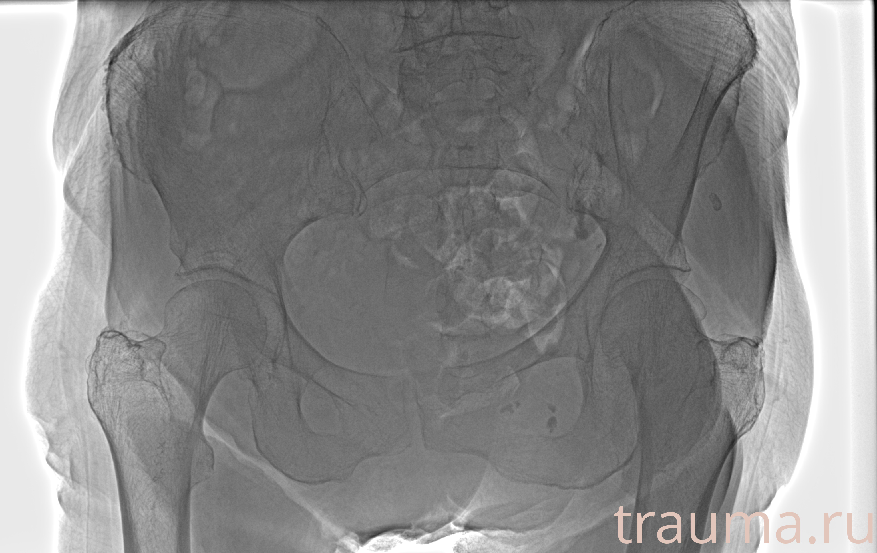 Рентген на дому: по вашему адресу приезжает врач-рентгенолог, травматолог-ортопед с мобильным рентгеновским аппаратом, проводит диагностику травмы или заболевания, делает необходимые рентгенограммы, дает рекомендации по дальнейшему лечению. Получить качественные снимки в домашних условиях возможно благодаря уникальной методике, разработанной МосРентген Центром для института  Склифосовского