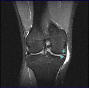 Магнитно-резонансно томографическая картина коленного сустава у пациентов в отдаленном периоде лечебной артроскопии при травмах хрящевого комплекса