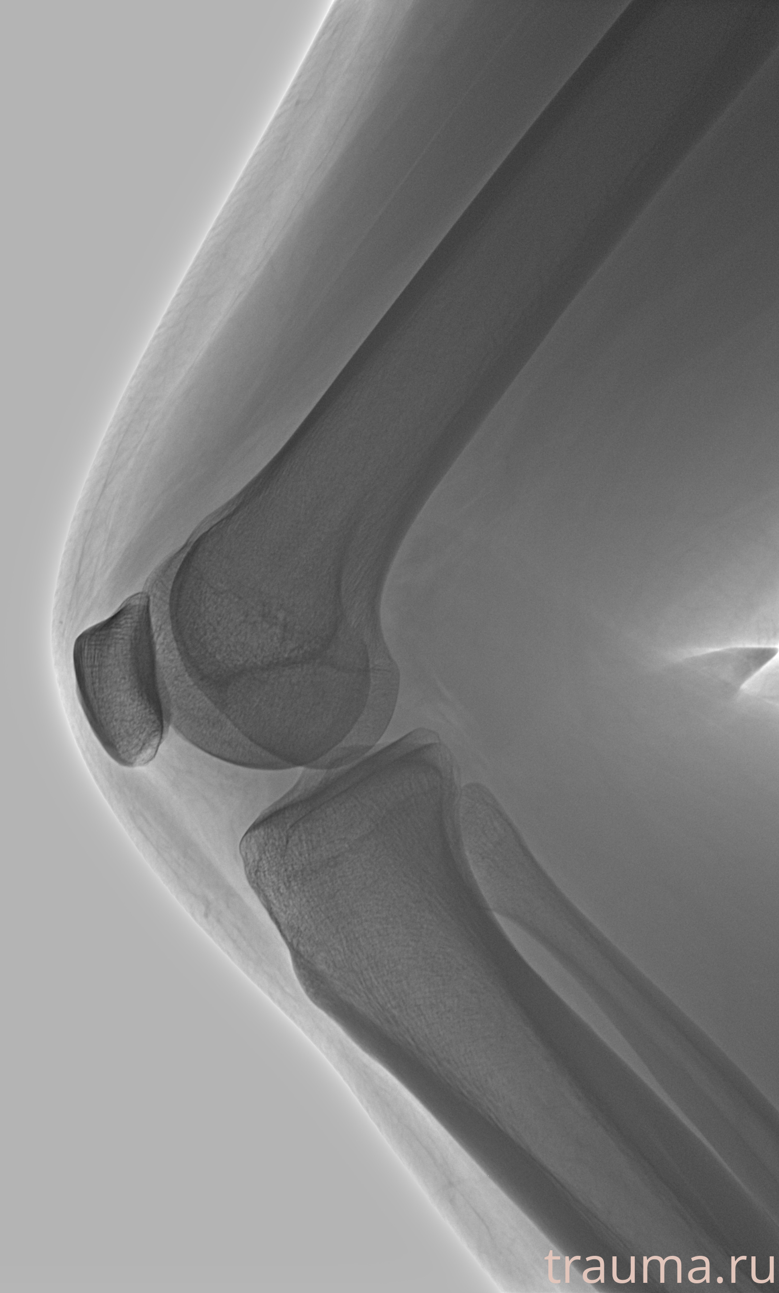 Рентген на дому: по вашему адресу приезжает врач-рентгенолог, травматолог-ортопед с мобильным рентгеновским аппаратом, проводит диагностику травмы или заболевания, делает необходимые рентгенограммы, дает рекомендации по дальнейшему лечению. Получить качественные снимки в домашних условиях возможно благодаря уникальной методике, разработанной МосРентген Центром для института  Склифосовского