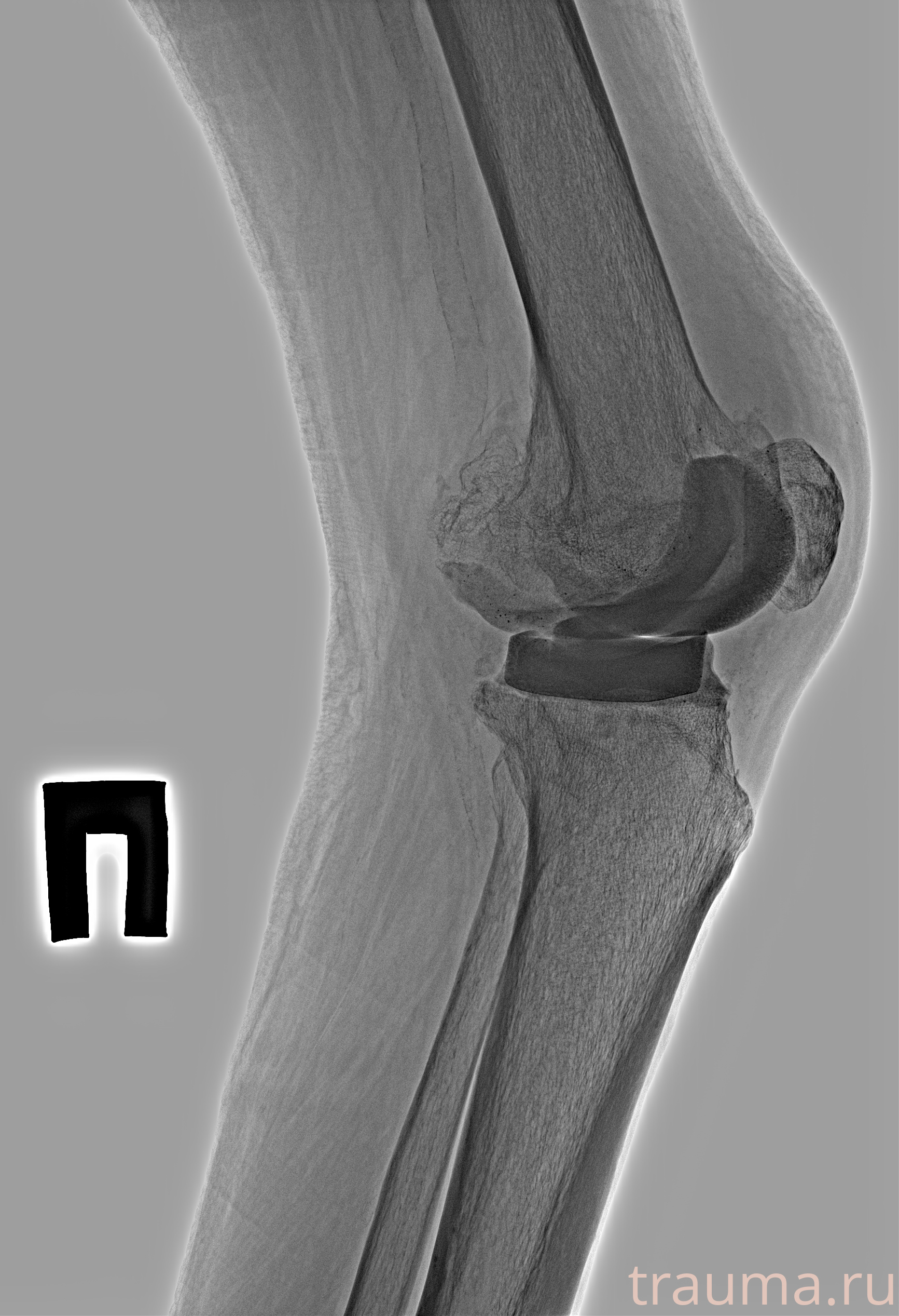 Рентген на дому: по вашему адресу приезжает врач-рентгенолог, травматолог-ортопед с мобильным рентгеновским аппаратом, проводит диагностику травмы или заболевания, делает необходимые рентгенограммы, дает рекомендации по дальнейшему лечению. Получить качественные снимки в домашних условиях возможно благодаря уникальной методике, разработанной МосРентген Центром для института  Склифосовского