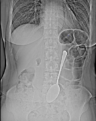 Врачи не поверили глазам, взглянув на рентген пациентки