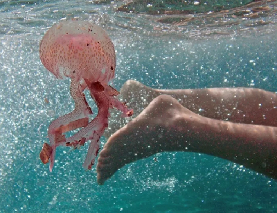 В Склифе помогли пациентке, которую ужалила медуза во время отдыха на Гоа